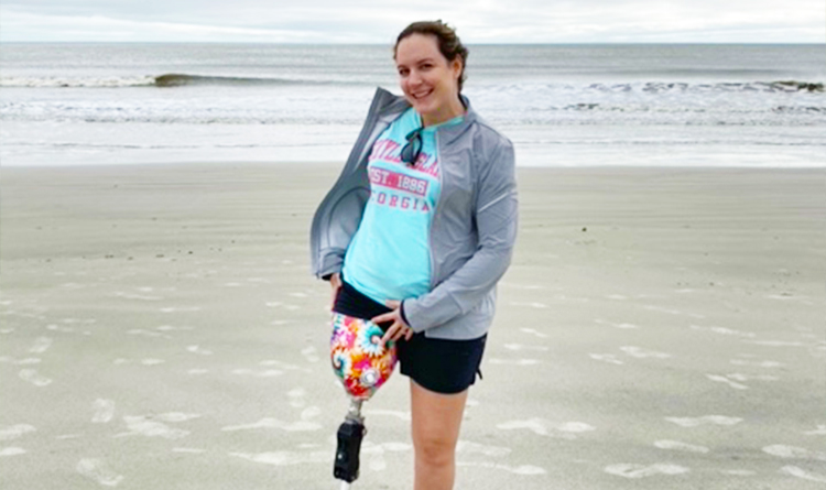 A PCOC patient showing off her prosthetic leg at the beach